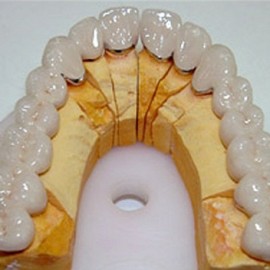 Bọc răng sứ cho răng khấp khểnh