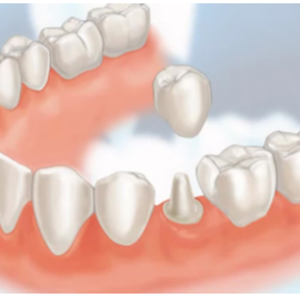 Những triệu chứng của viêm lợi sau khi bọc răng sứ là gì?