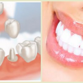 Chết tủy sau khi bọc răng sứ có ảnh hưởng tới răng không?