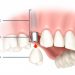 Quy trình cấy ghép implant diễn ra gồm các bước nào