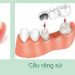 Trồng răng giả giá bao nhiêu tại biên hòa