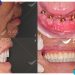 Peace Dentistry nha khoa cấy ghép implant tin cậy của Việt Kiều tại sài gòn